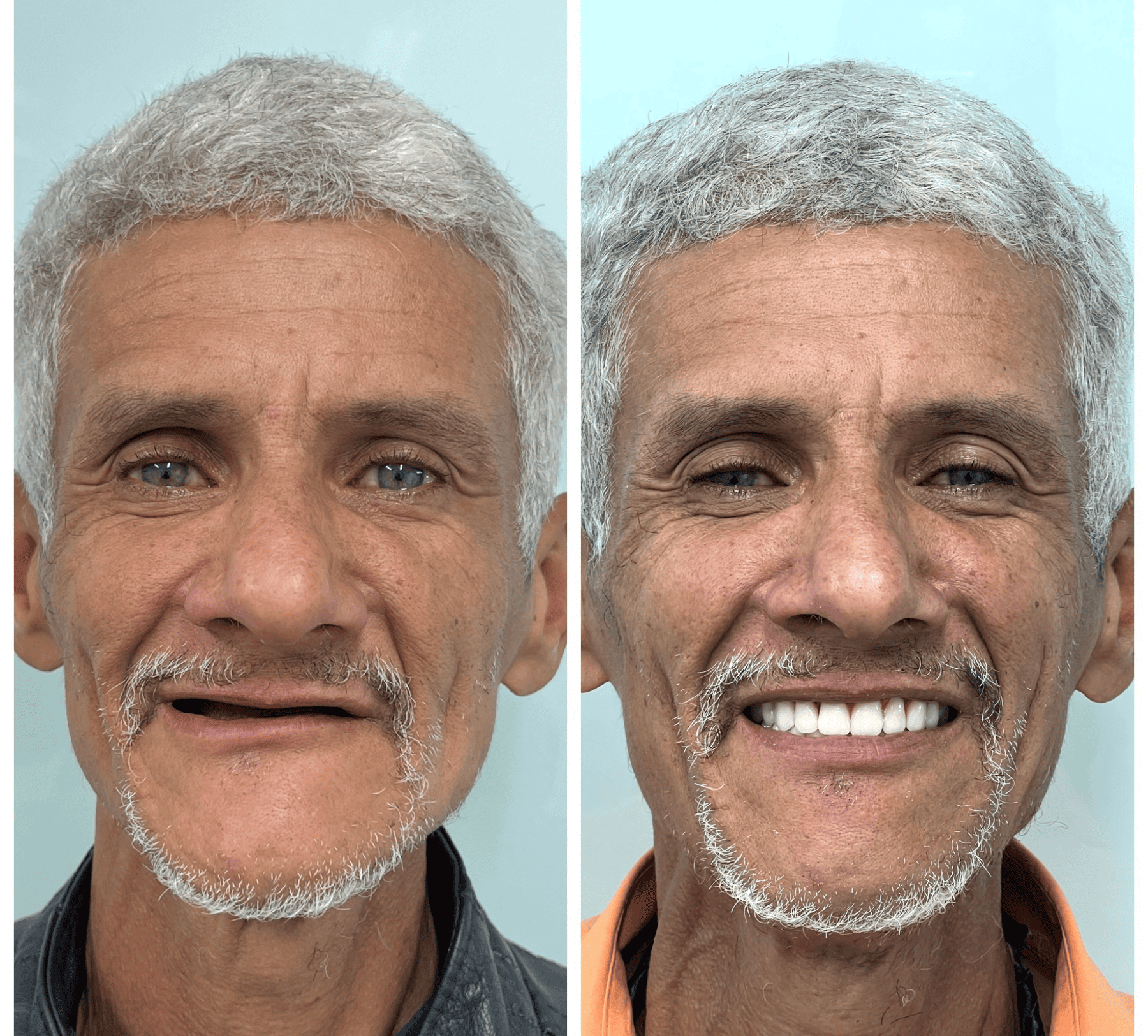 implante dentario belo horizonte dr alysson ramos 1