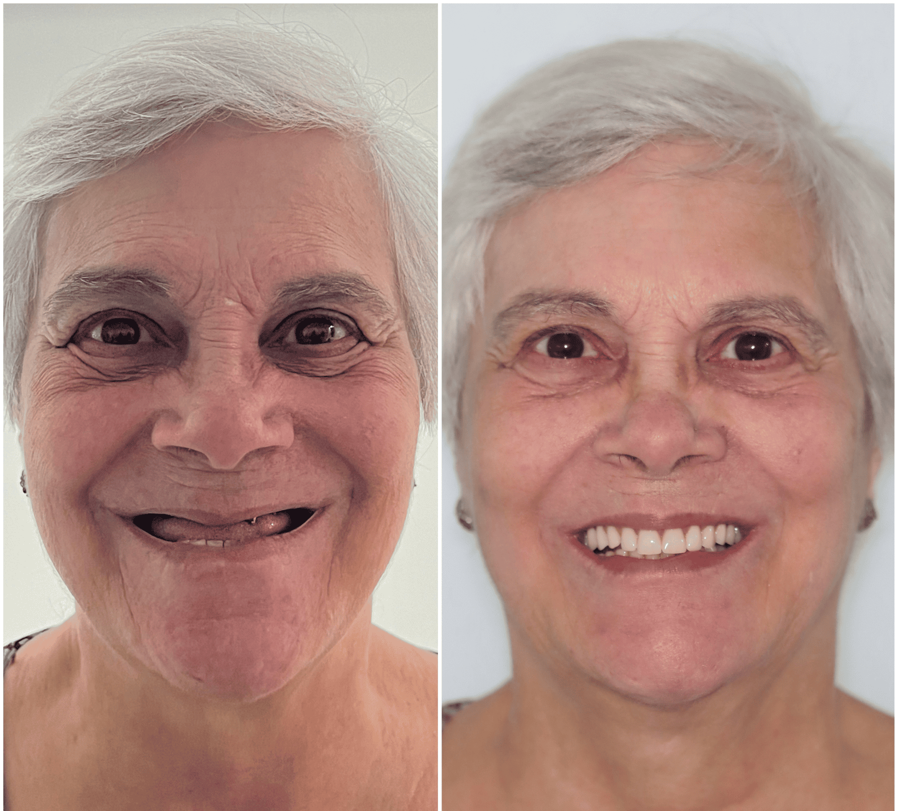 implante dentario belo horizonte dr alysson ramos 2