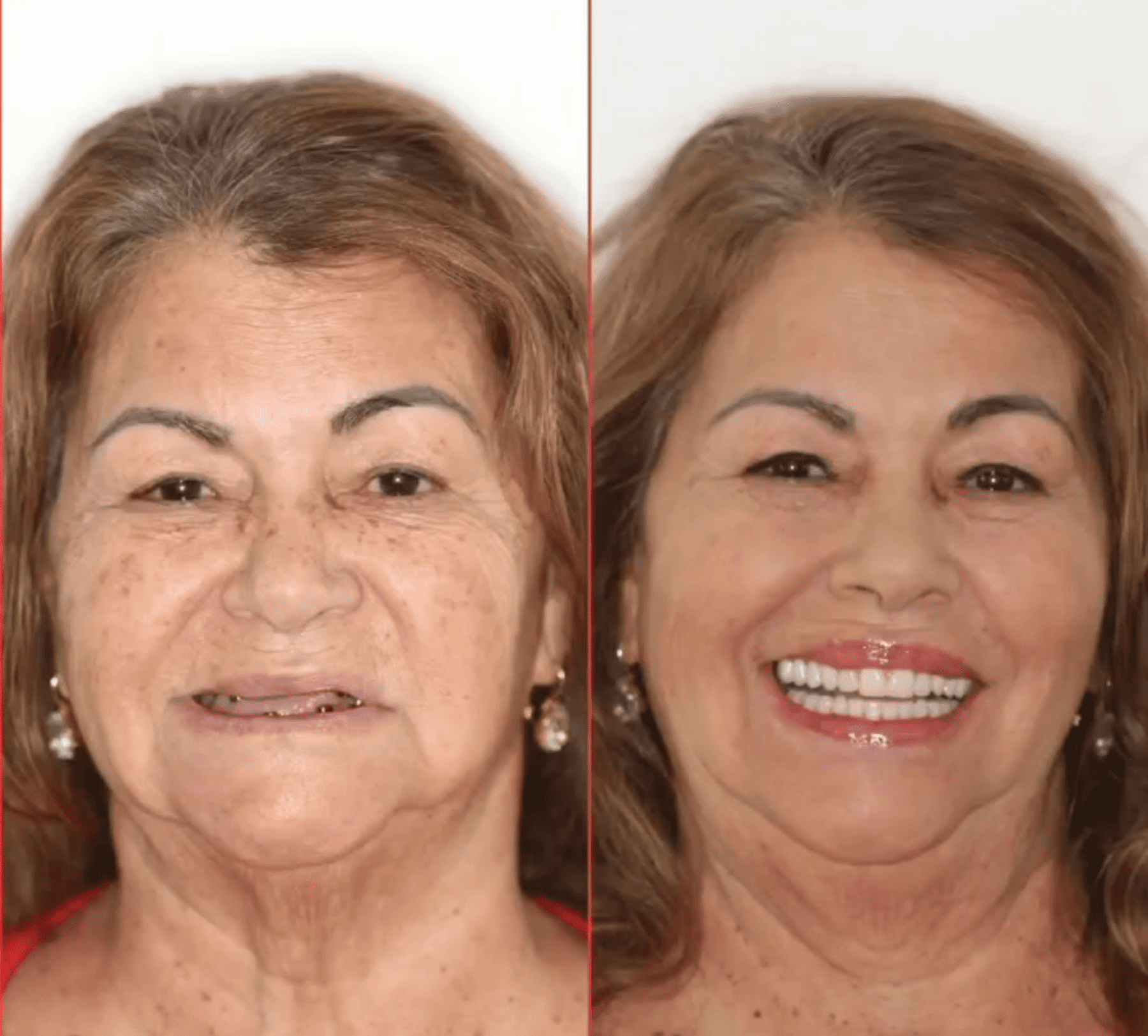 implante dentario belo horizonte dr alysson ramos 3