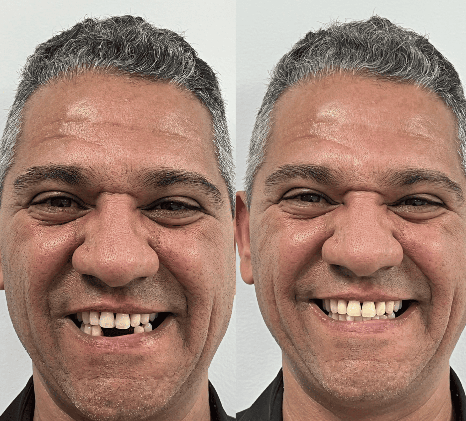 implante dentario belo horizonte dr alysson ramos 4