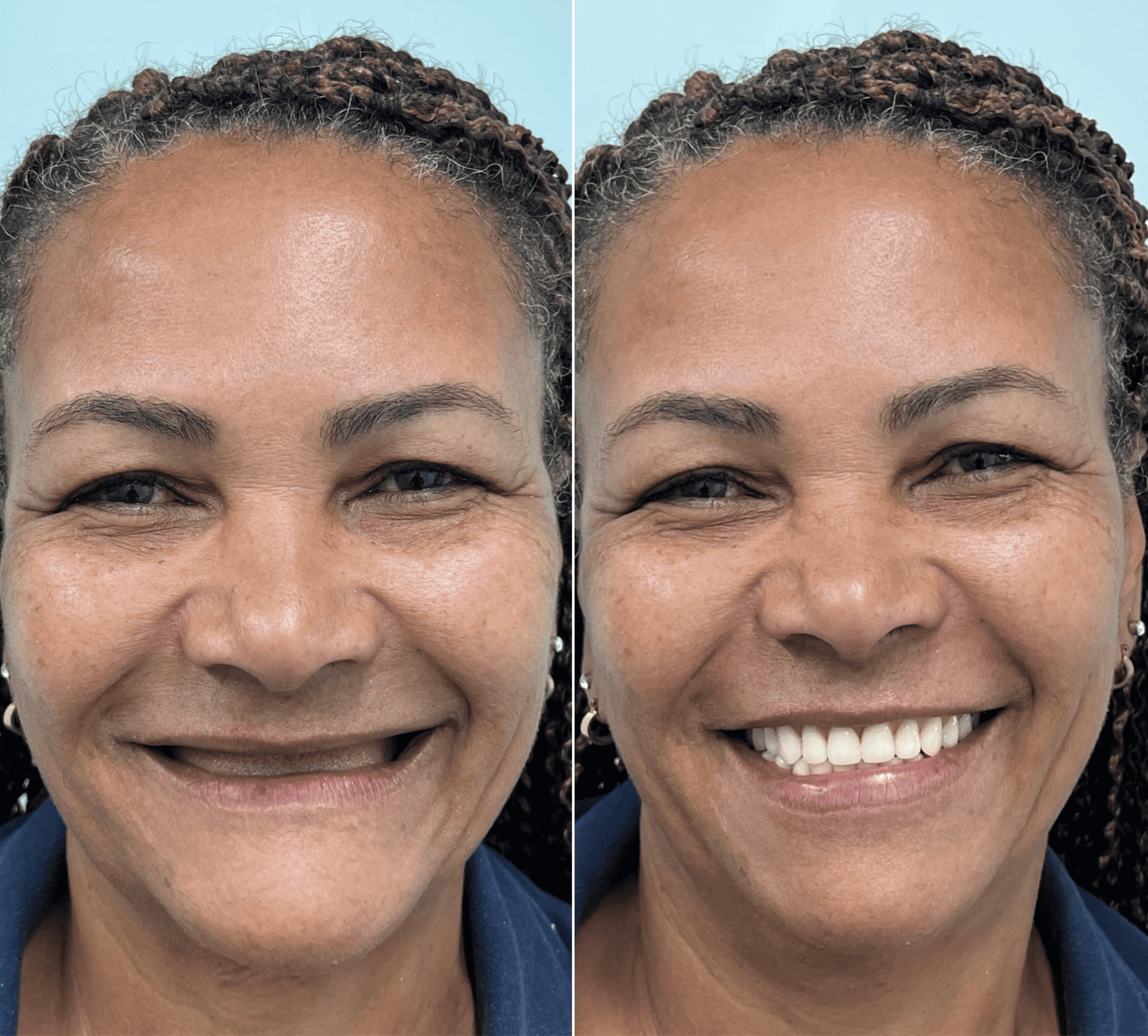implante dentario belo horizonte dr alysson ramos 6