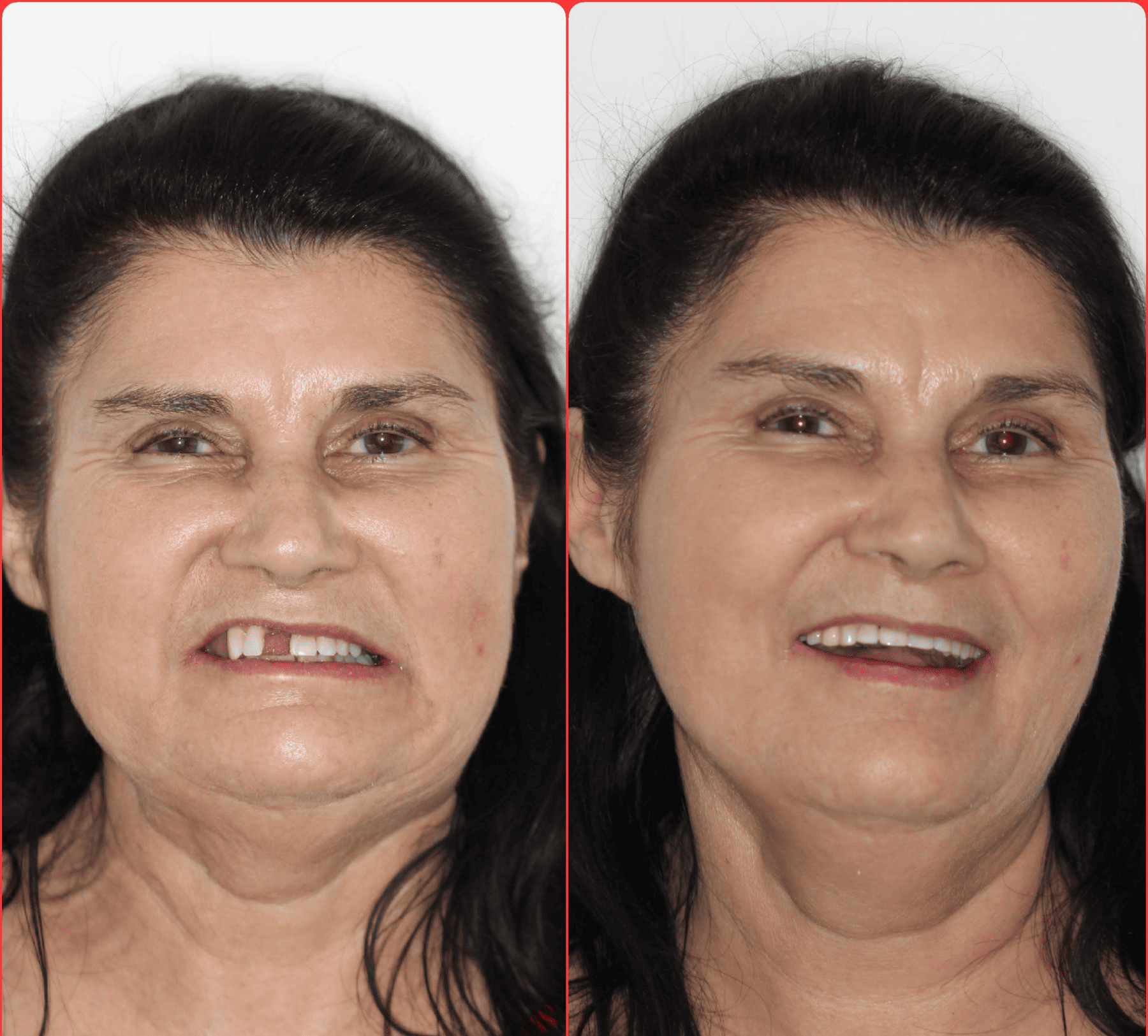 implante dentario belo horizonte dr alysson ramos 7